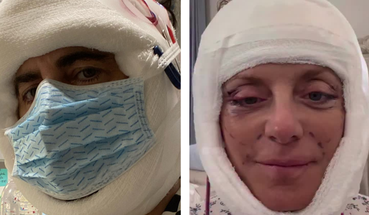 Marc Jacobs (left) in bandages post-facelift; Kathy Wilke (right) in bandages post-facelift