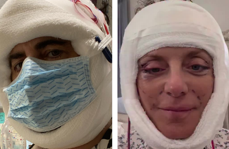 Marc Jacobs (left) in bandages post-facelift; Kathy Wilke (right) in bandages post-facelift
